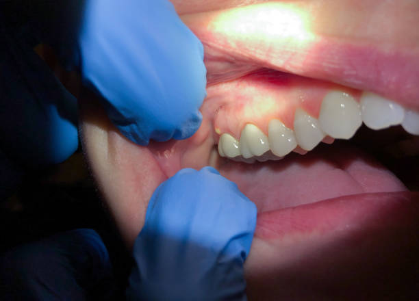 Best Emergency Treatment for Toothache in Abingdon, MD